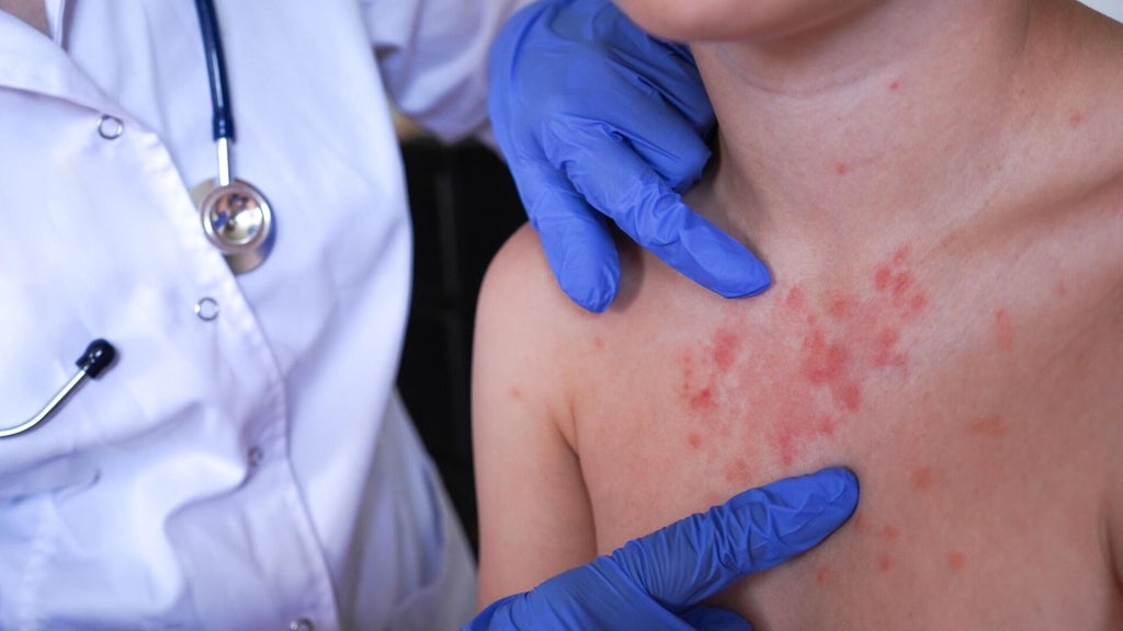 Minnesota's 80 measles cases this year are the most since 1990, health officials say — Chaska Health news